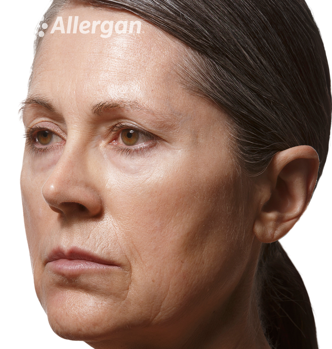 Juvederm | Caucasian female model 1 After angled